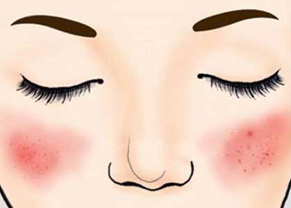 深圳油压按摩告诉你秋季脸部出现红血丝怎么处理